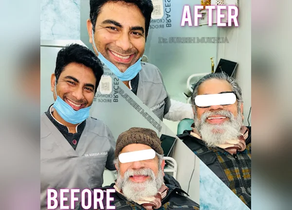 Full Mouth Rehabilitation In Noida