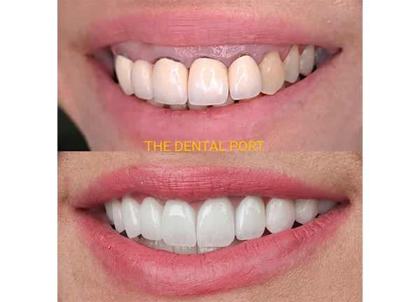 Dental Veneers in Noida