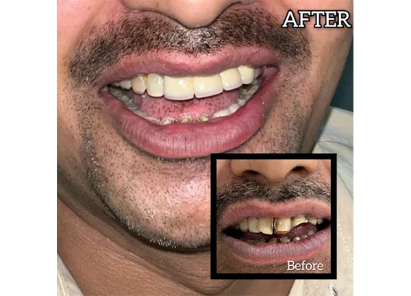 Smile makeover in Noida