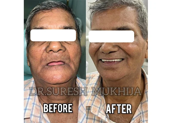 Implant supported dentures