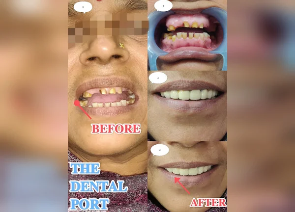 missing-teeth-replacement-implants-noida