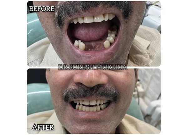 Smile makeover in Noida