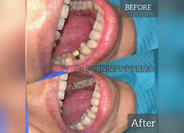 zirconia crown in Noida