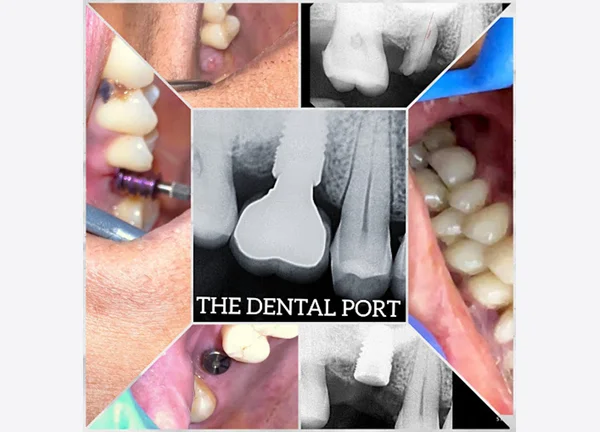Dental implants Noida