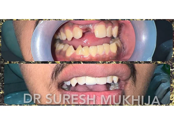 Dental implants at THE DENTAL PORT