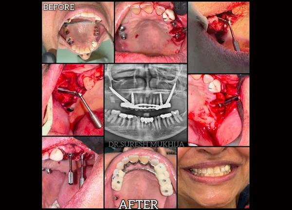 Teeth in a day