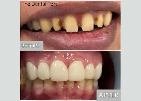 Dental Veneers in Noida