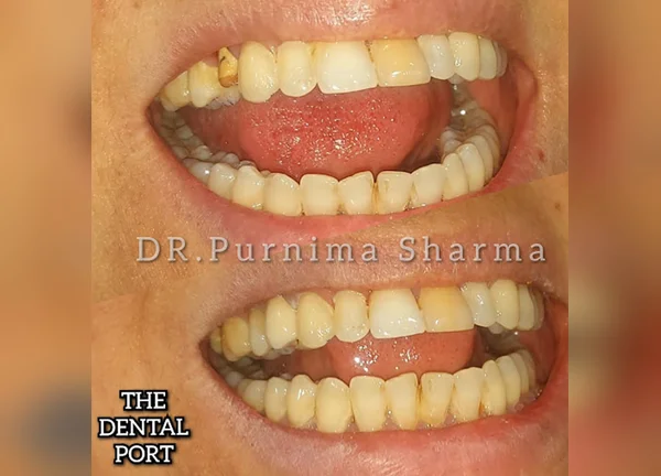 zirconia crown in Noida