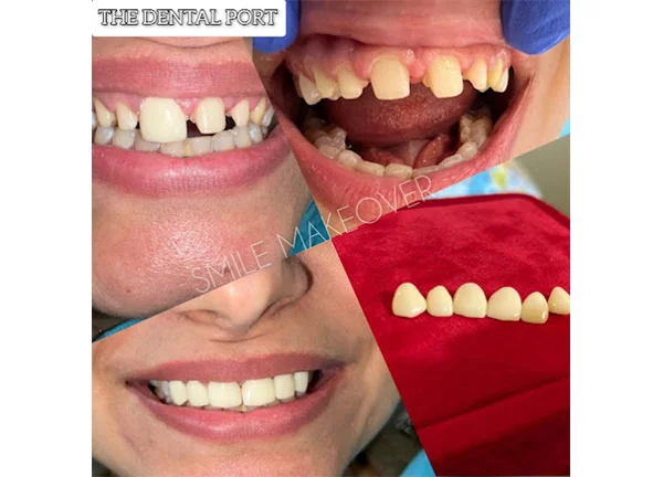 Dental Veneers in Noida sector 168
