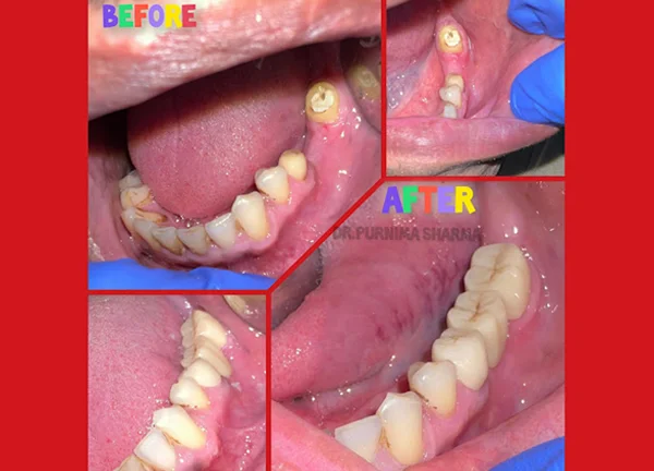 Dental Crown