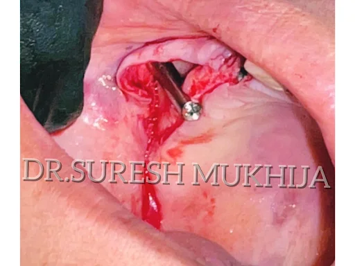 Zygomatic Implants in Noida