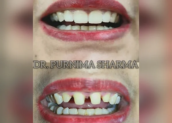 best-dental-veneers-clinic-noida