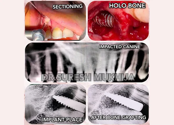 full-mouth-rehab-zygoma-implants-the-dental-port
