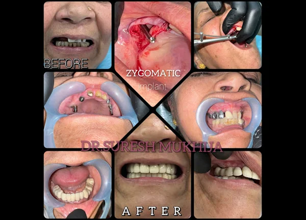 full-mouth-dental-implants-noida
