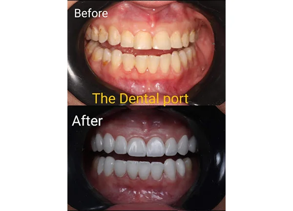 Smile transformation in Noida