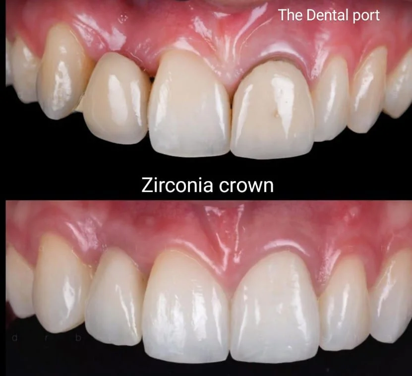 zirconia crown in Noida