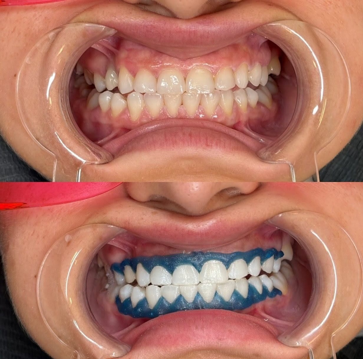 Laser teeth whitening at THE DENTAL PORT