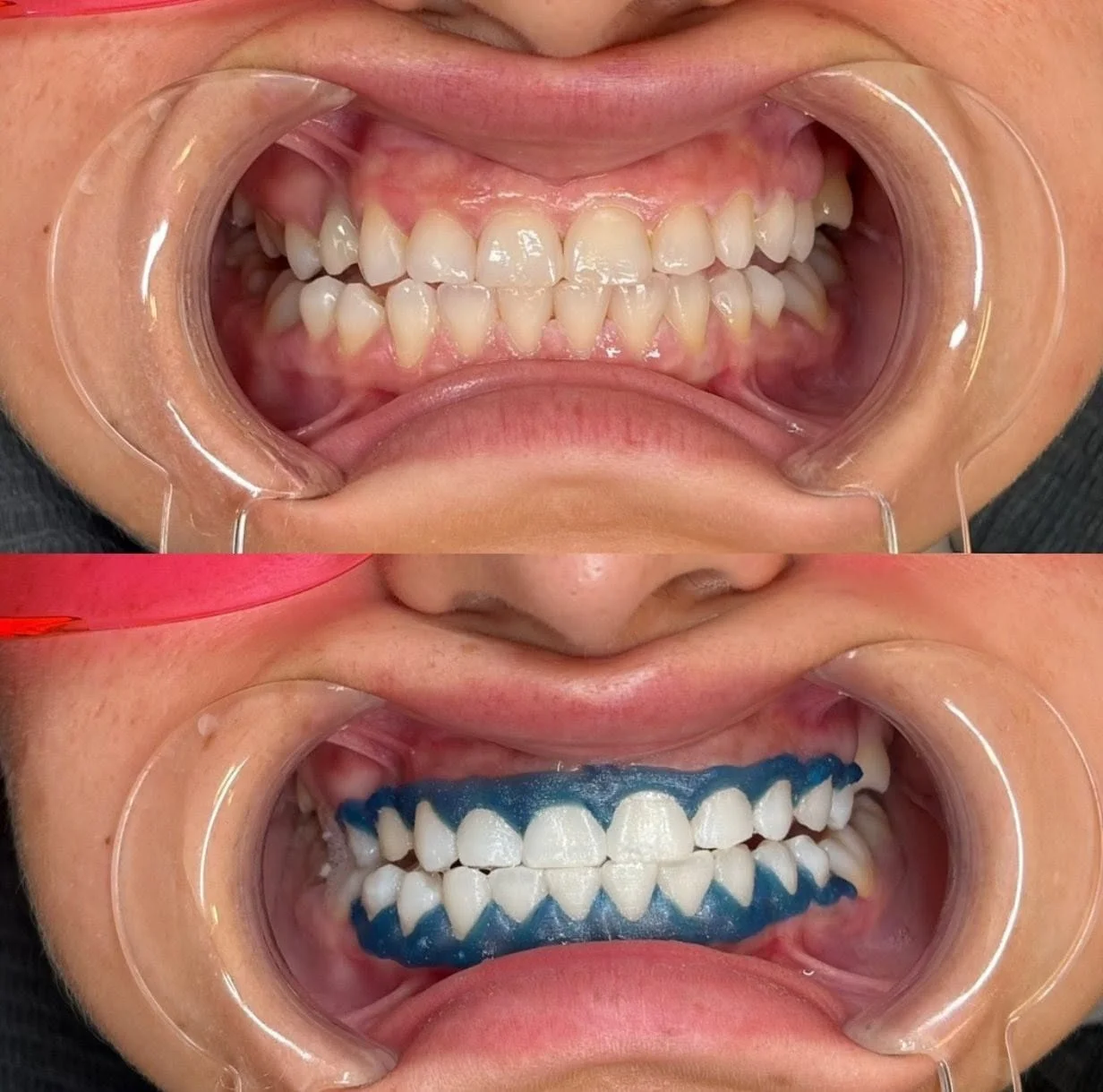 Laser teeth whitening at THE DENTAL PORT