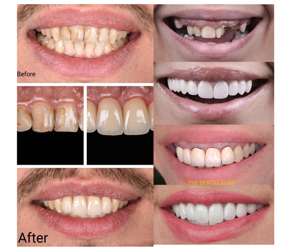 Smile Designing in Noida  The Dental Port Sector 168