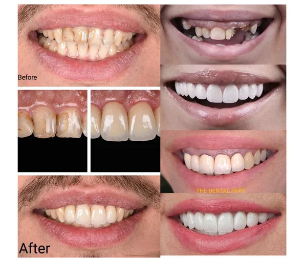 Smile Designing in Noida  The Dental Port Sector 168