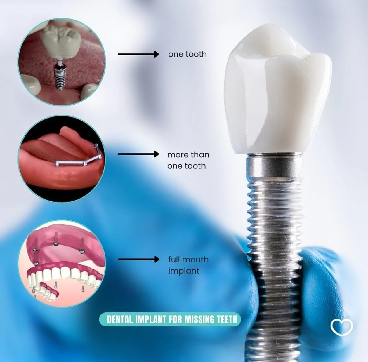 Dental Implants